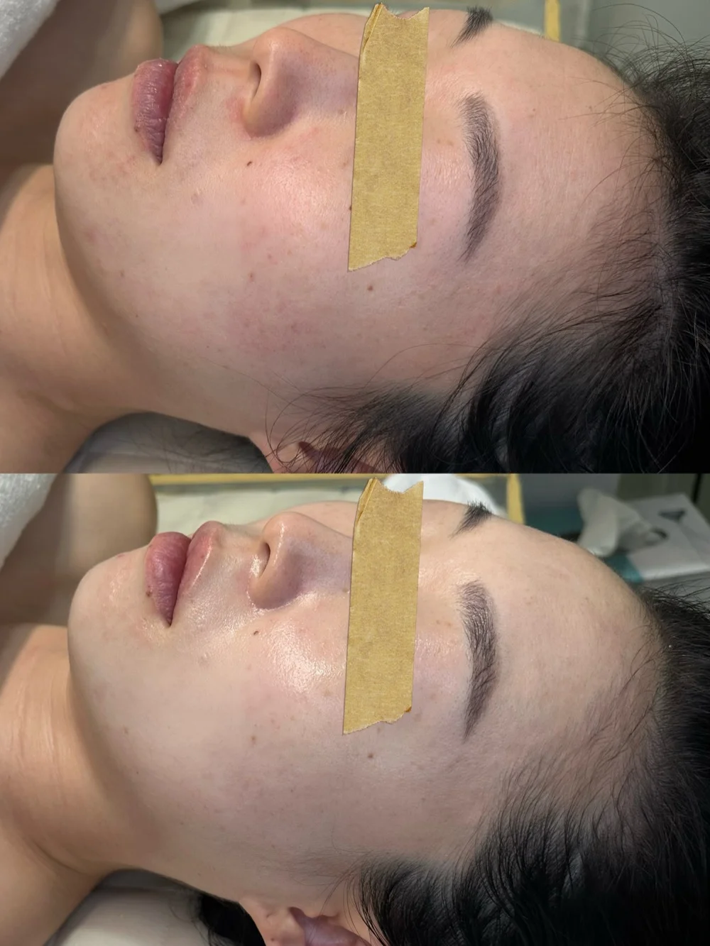 LDM skin care treatment